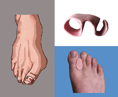 orthoplastie podologue perpignan